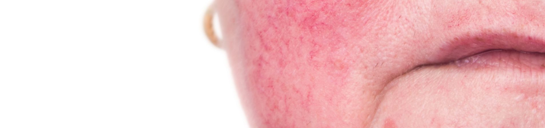 What is Rosacea & Why do you get it?