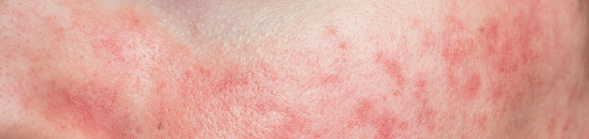 Rules for Rosacea