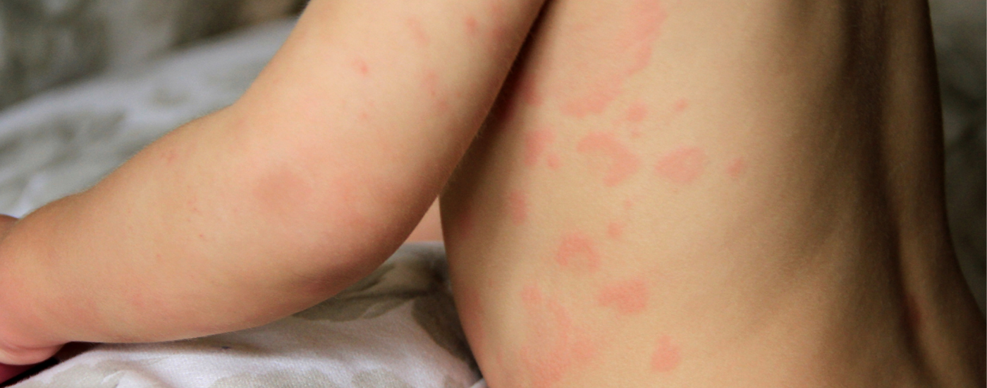 Childhood Eczema Skincare: latest evidence
