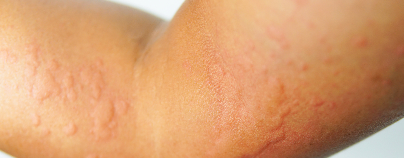 Skintelligence: Bad Skin Reactions & What to Do About Them?