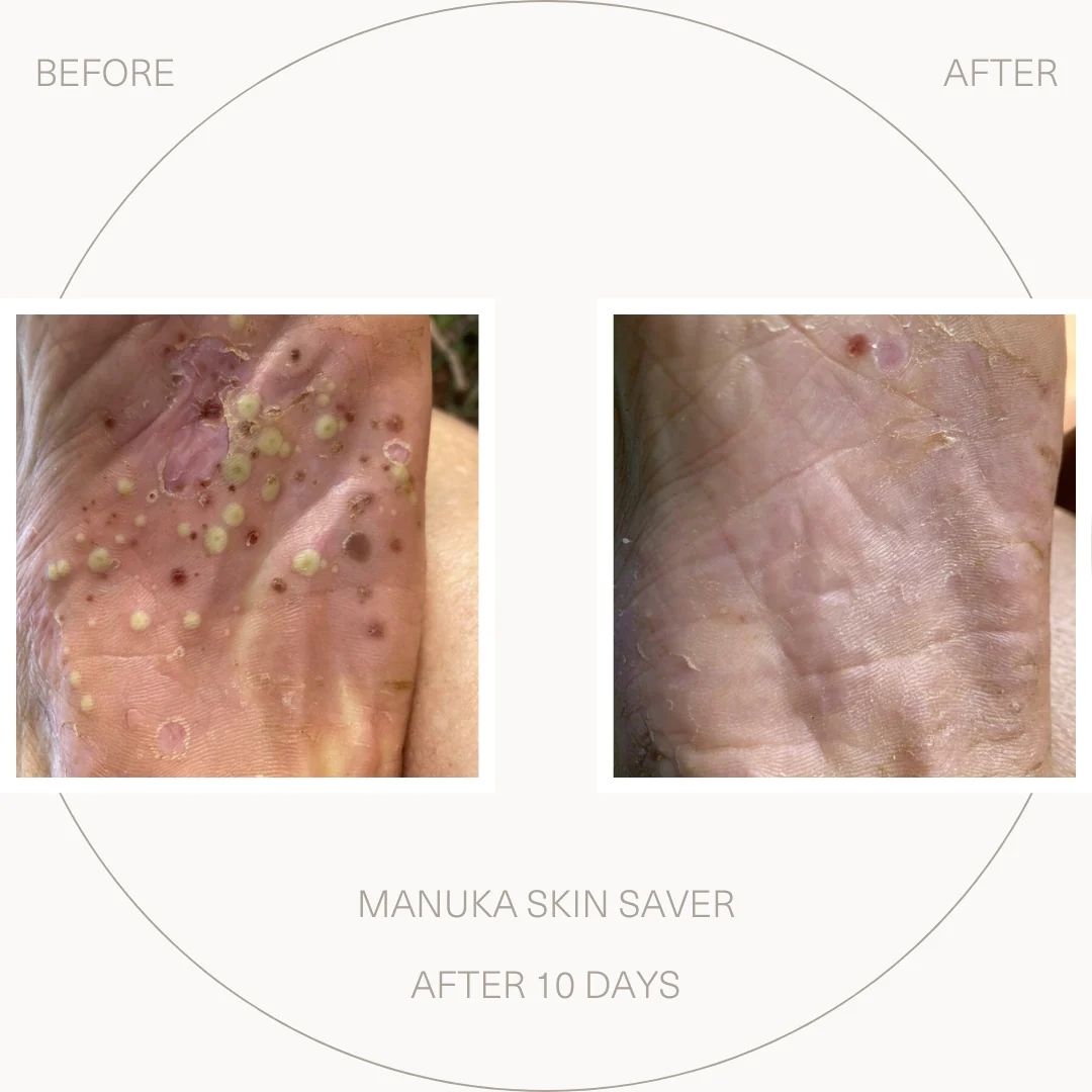 Free Manuka Skin Saver (~)