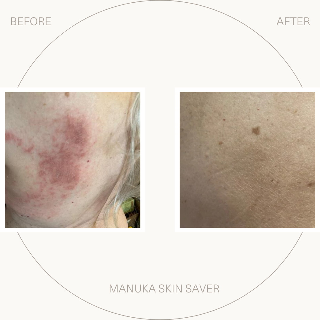Manuka Skin Saver - Psoriasis Prone Skin 1.69 Fl Oz