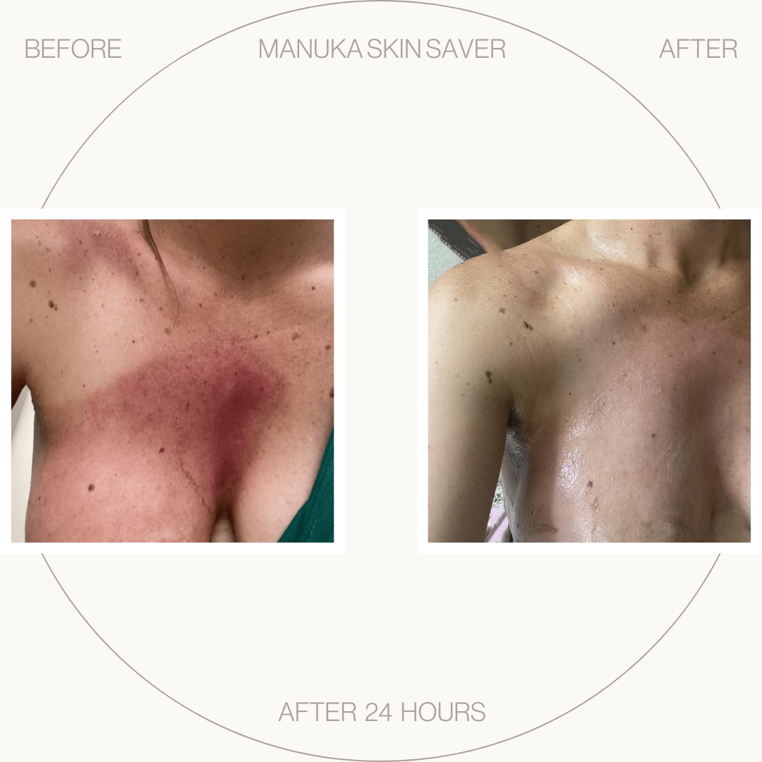 Manuka Skin Saver - Radiation &amp; UV Damage
