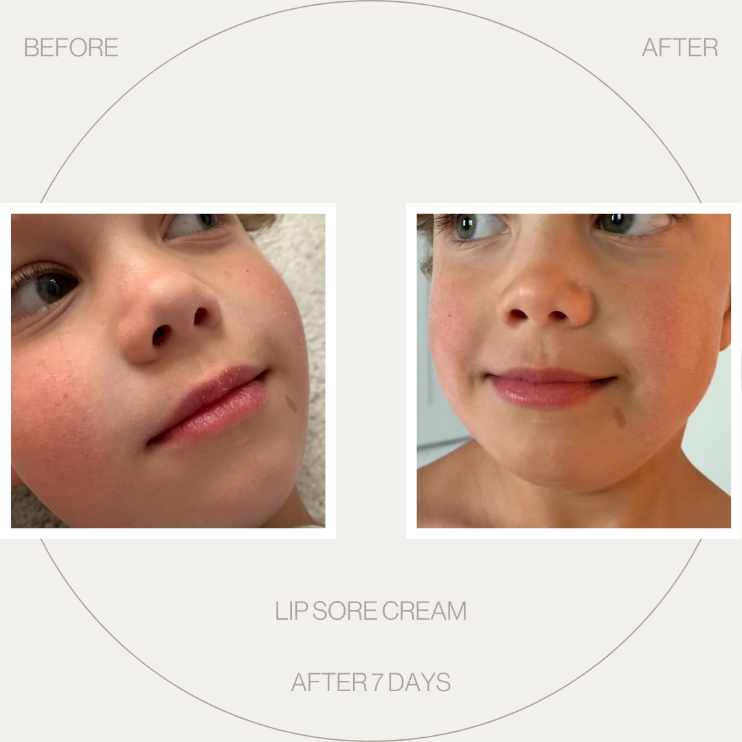 Lip sore cream work on kid