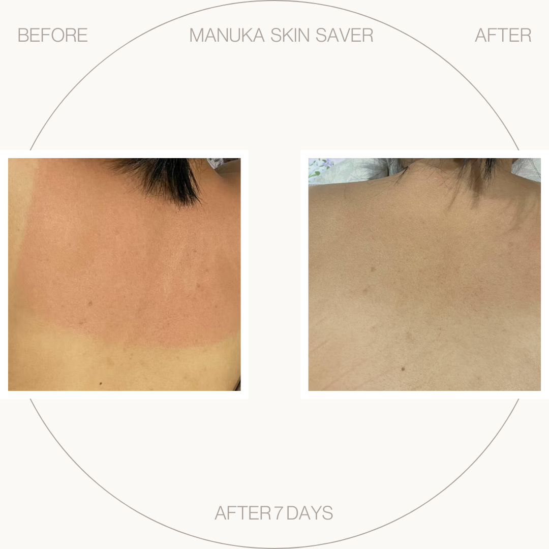 Manuka Skin Saver - Radiation &amp; UV Damage